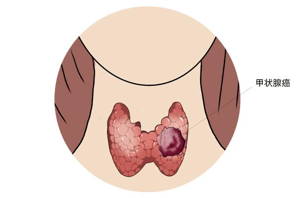 甲狀腺癌癥的主要癥狀表現(xiàn)有什么？為什么會(huì)得甲狀腺癌癥呢？